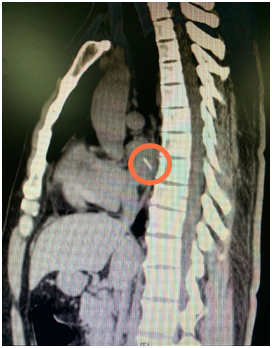 5胸部CT片 画圈处为鱼刺.png